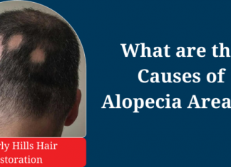 What are the Causes of Alopecia Areata?
