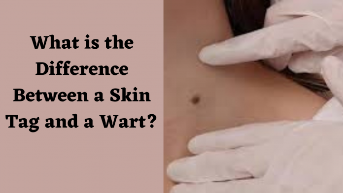 What is the Difference Between a Skin Tag and a Wart