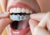Invisalign Near Me – My Experience With Invisalign invisalign near me