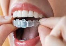 Invisalign Near Me – My Experience With Invisalign invisalign near me